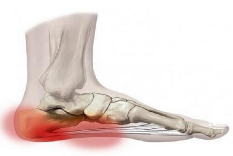 Preventative Treatment and Rehabilitation for Plantar Fascia: FPO