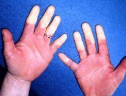 Raynaud’s Syndrome